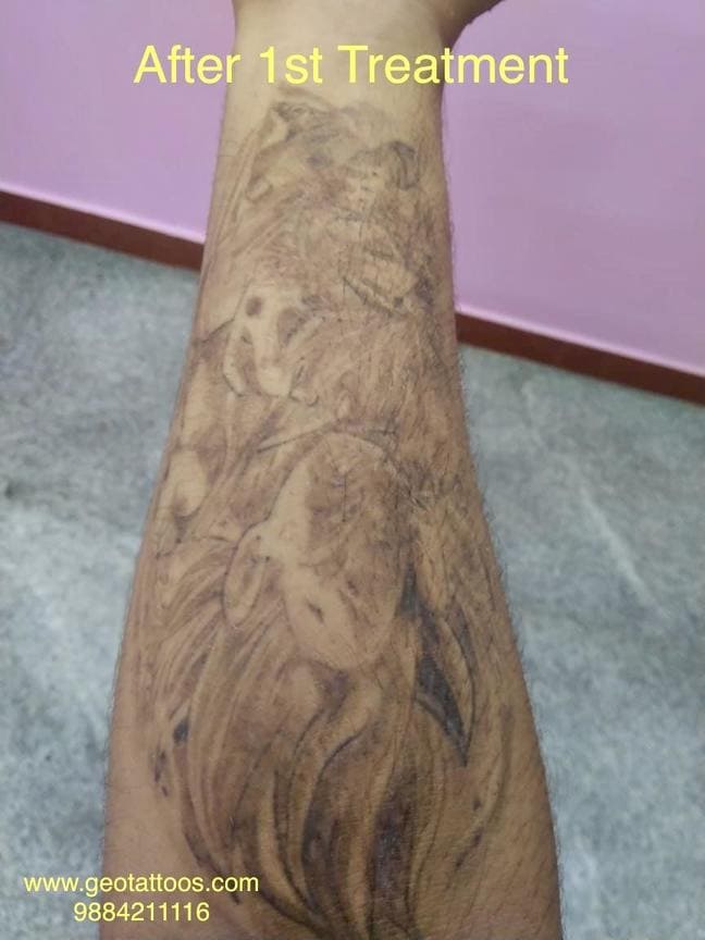 gallery/Geo_Tattoos_Removal-1.jpg