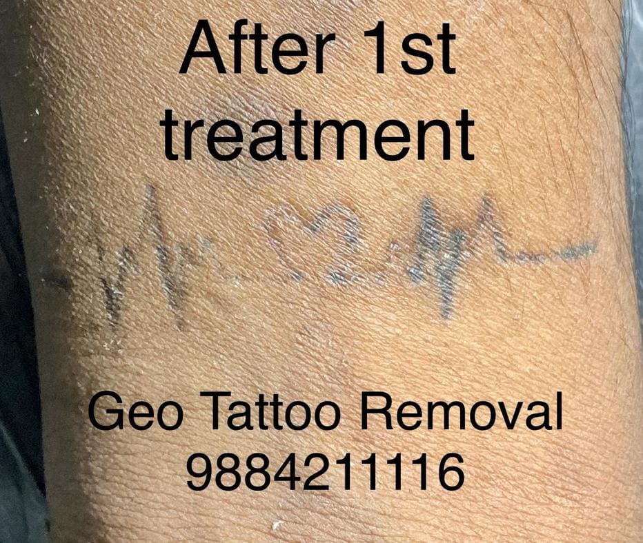 gallery/Geo_Tattoos_Removal-10.jpg