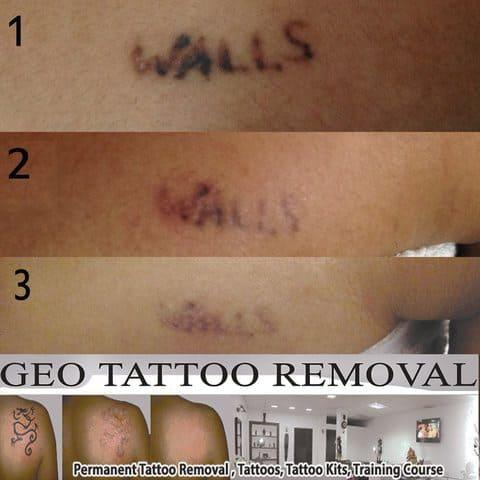 gallery/Geo_Tattoos_Removal-13.jpg