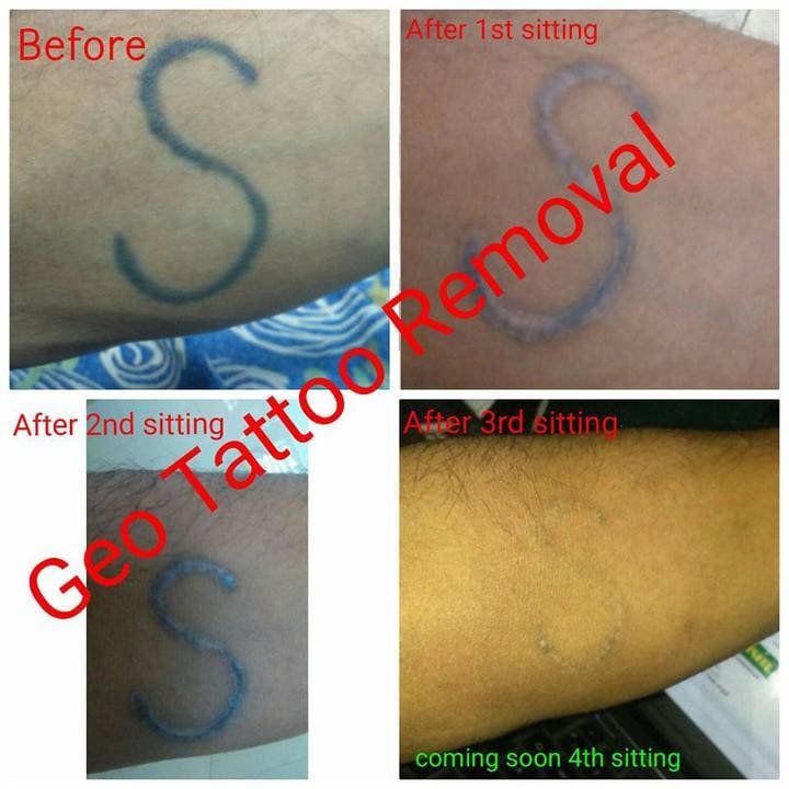 gallery/Geo_Tattoos_Removal-4.jpg